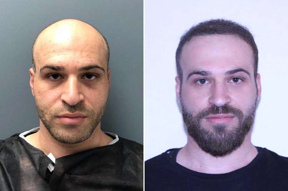 Hair transplant - Hair surgery