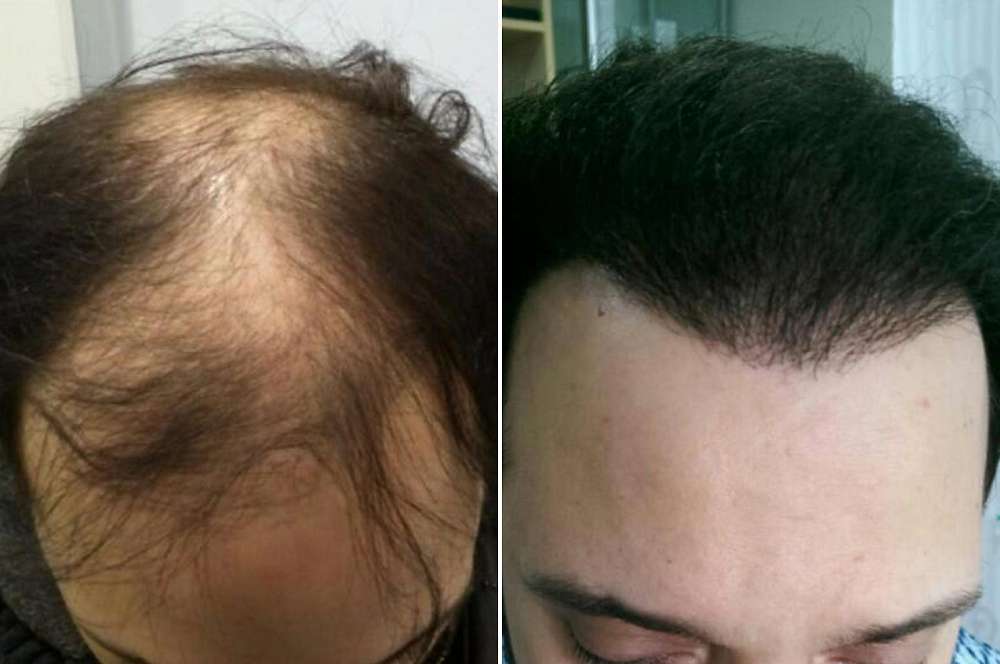 Hair transplant - Hair surgery