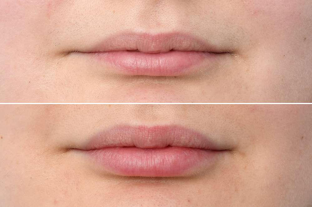 Lip fillers - Injectables