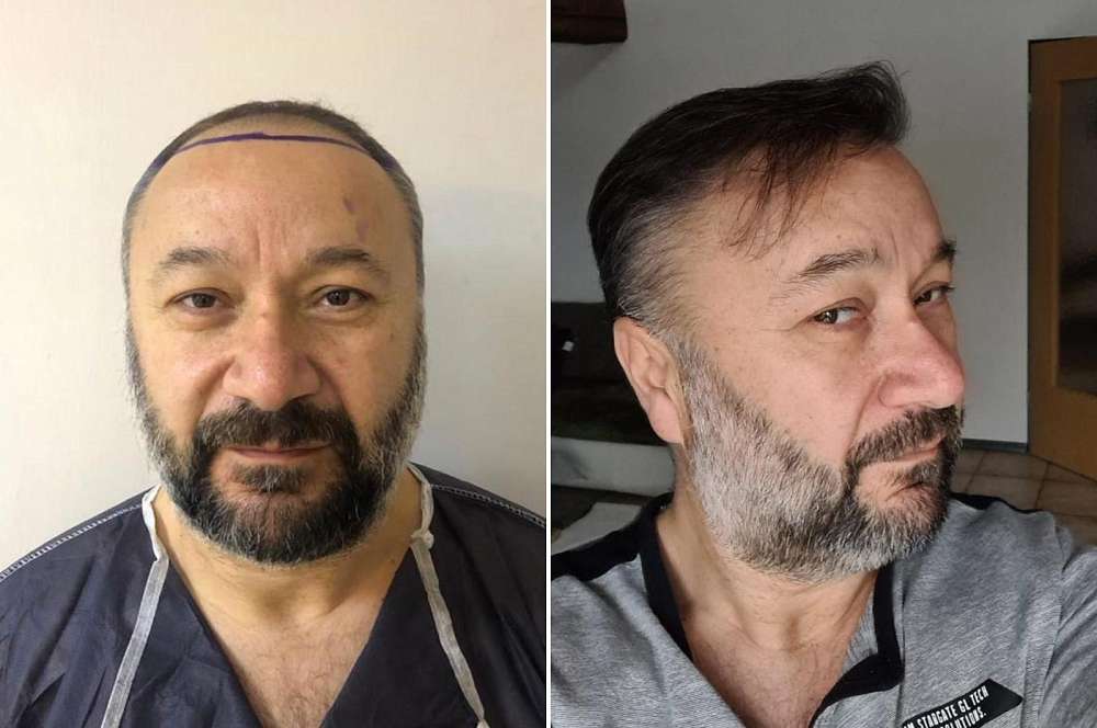 Hair transplant - Hair surgery