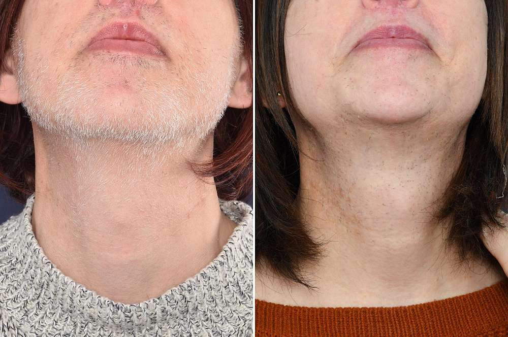 Electrolysis - Hair removal
