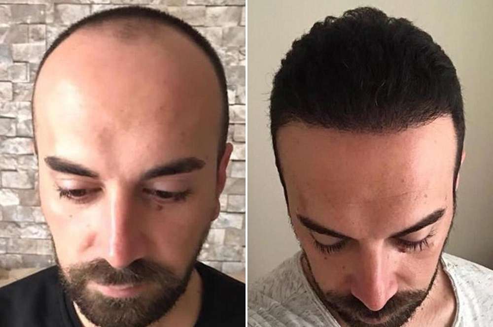 Hair transplant - Hair surgery