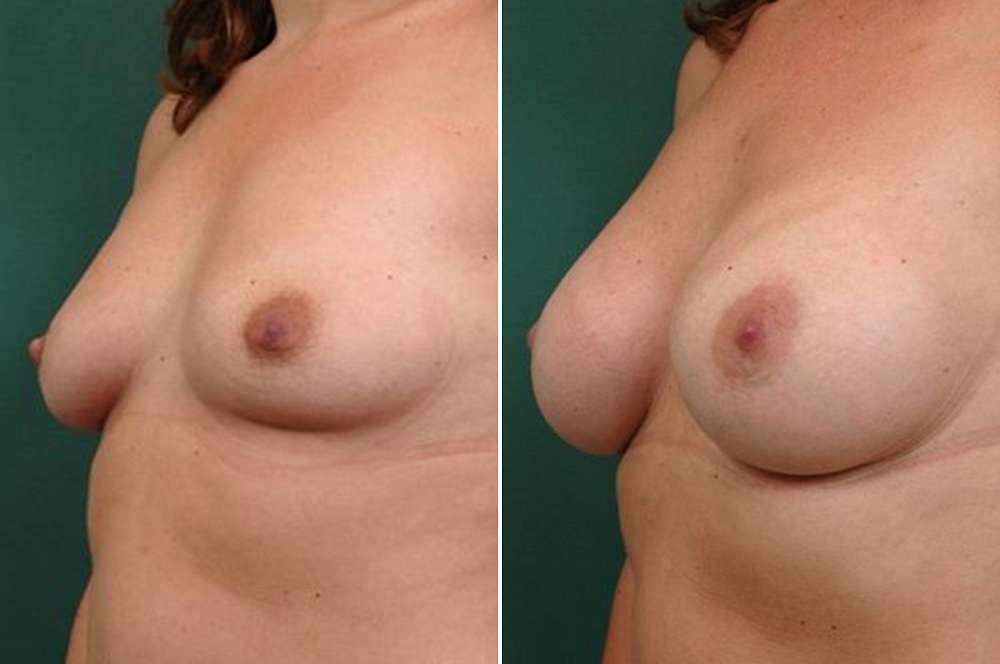 Breast augmentation - Body surgery