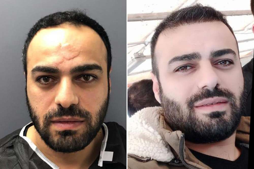 Hair transplant - Hair surgery
