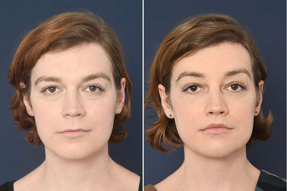 Facial surgery - Facial surgery