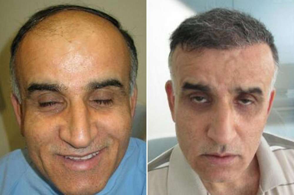 Hair transplant - Hair surgery