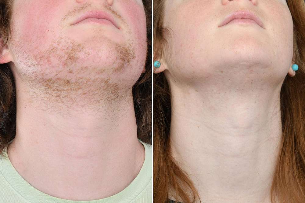 Electrolysis - Hair removal