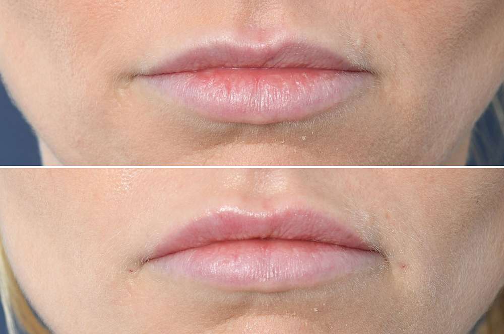 Lip fillers - Injectables