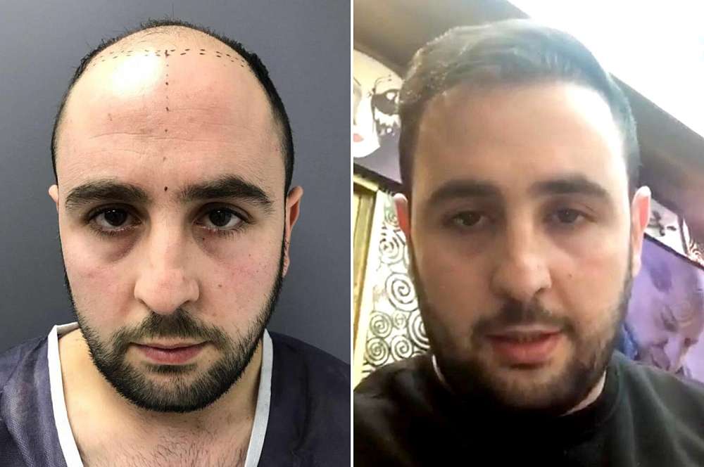 Hair transplant - Hair surgery